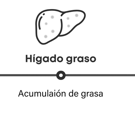 Cómo progresa la MASH: hígado graso tiene acumulación de grasa