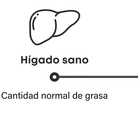 Cómo progresa la MASH: el hígado sano tiene una cantidad normal de grasa