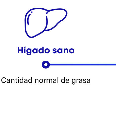 Cómo progresa la MASH: el hígado sano tiene una cantidad normal de grasa
