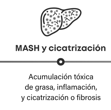 Cómo progresa la MASH: la MASH y la cicatrización en el hígado pueden causar acumulación de grasa tóxica, inflamación y formación de tejido cicatricial o fibrosis.