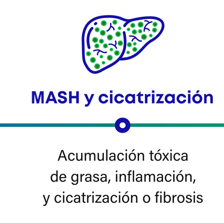 Cómo progresa la MASH: la MASH y la cicatrización en el hígado pueden causar acumulación de grasa tóxica, inflamación y formación de tejido cicatricial o fibrosis.